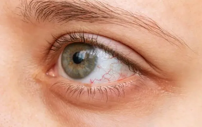 Férias exigem atenção com os olhos no tempo seco