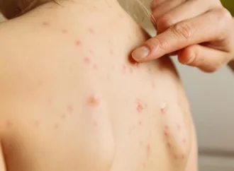 Goiás intensifica ações preventivas e de monitoramento contra o sarampo